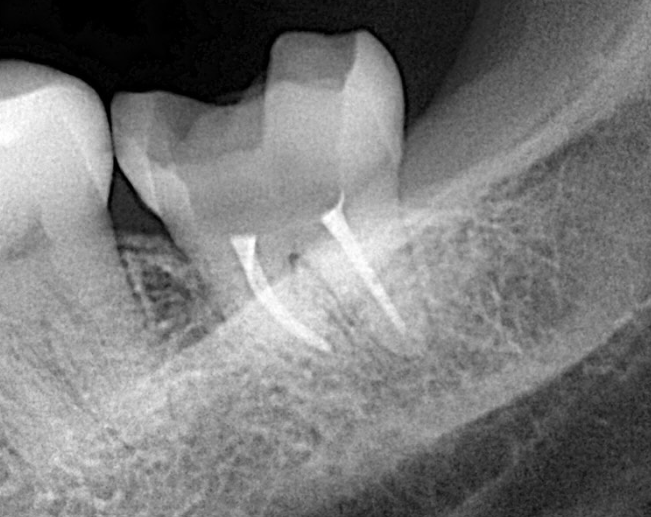 Radiografía dental digital